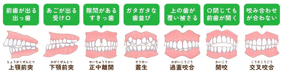 不正咬合