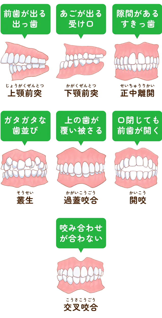 不正咬合