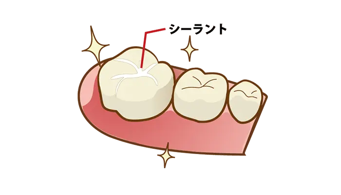 シーラント