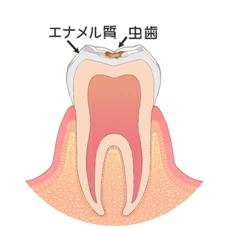 歯の表層（エナメル質）の虫歯