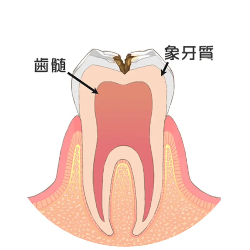 歯の中（象牙質）まで進行した虫歯