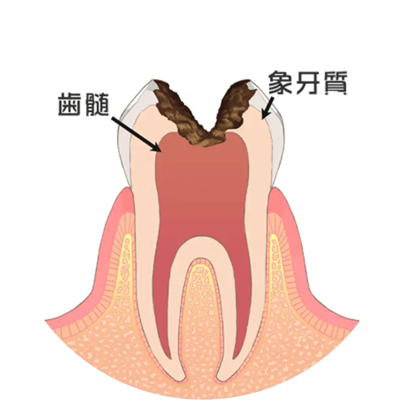 歯の神経まで達した虫歯