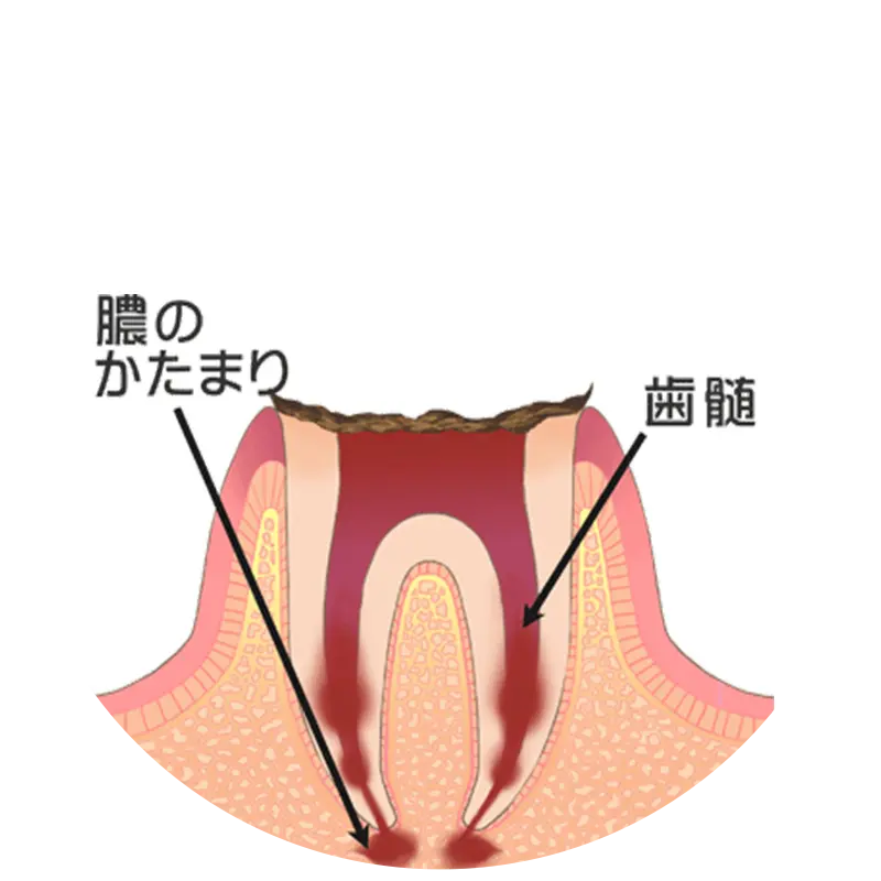 歯の根っこまで進行した虫歯