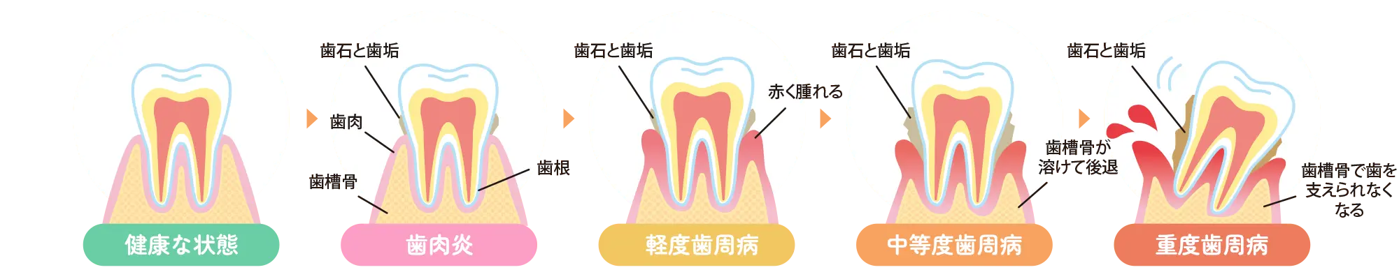 歯周病の進行