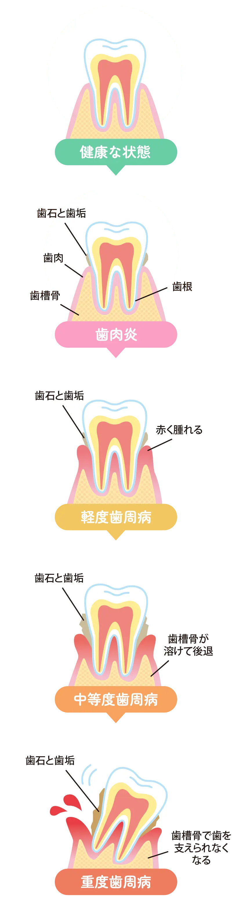 歯周病の進行
